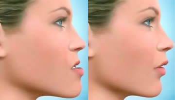 Cirurgia Buco Maxilo Facial