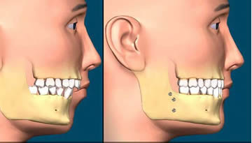 Cirurgia Ortagnática