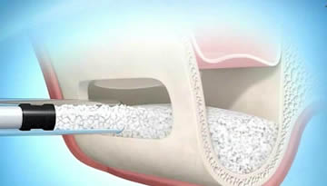 Enxertos e Reconstruções ósseas