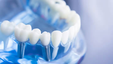 Implantes Dentários